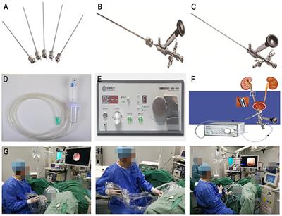 Comparison of the Efficacy of ShuoTong Ureteroscopy and Simple Flexible Ureteroscopy in the Treatment of Unilateral Upper Ureteral Calculi